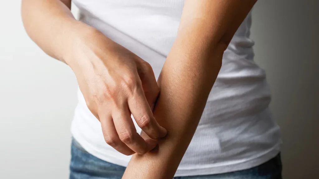 درماتیت تماس، اگزما