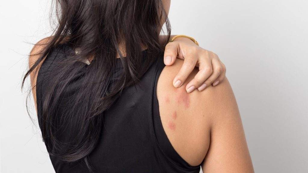 کهیر و درمان آن